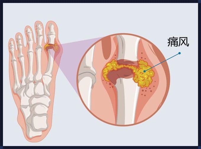 如何判断自己得了风湿病