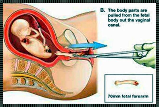 30周引产对女性伤害有多大