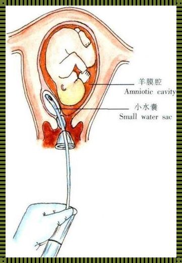 孕40周羊水偏少要催产吗？惊现！