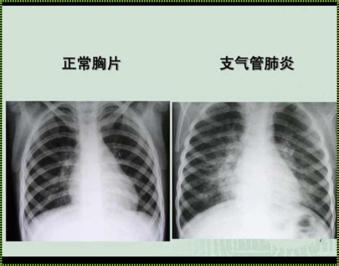 小儿支气管炎能否自愈：揭秘疾病背后的神秘面纱