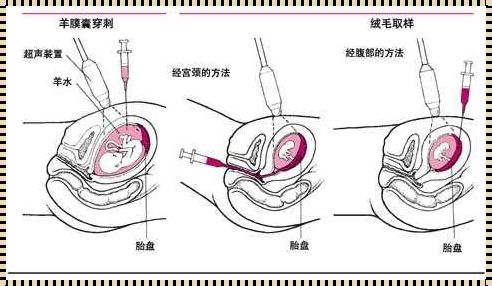 羊水穿刺：为胎儿健康保驾护航