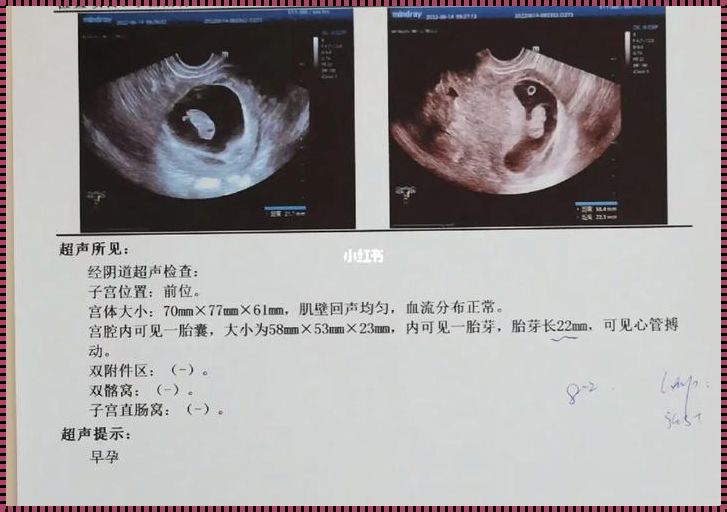 6周单胎8周变双胎：揭开神秘面纱