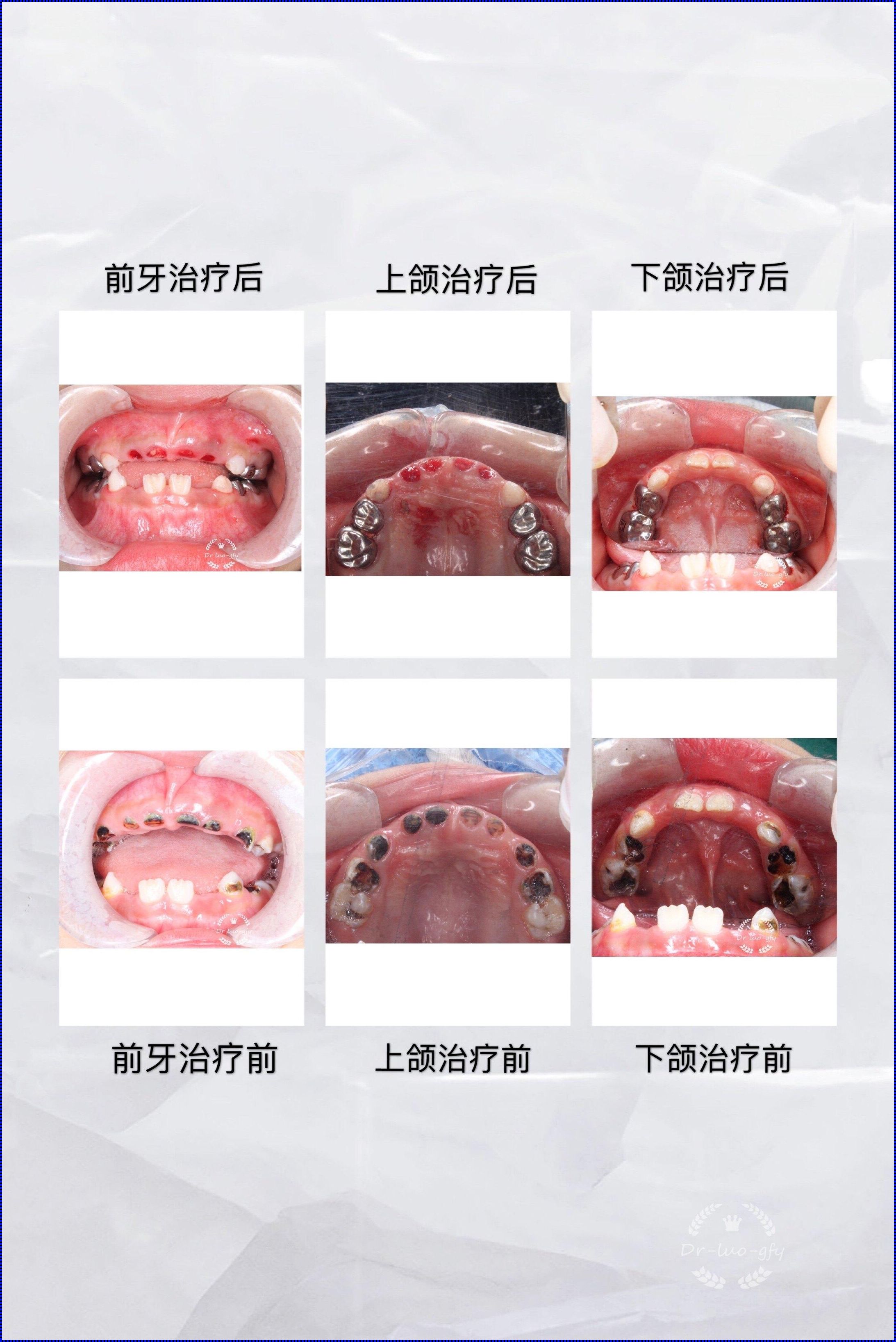 三岁小孩做根管治疗影响换牙吗？