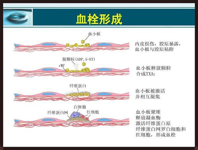 新生儿血栓的形成原因：探寻早期预防之路