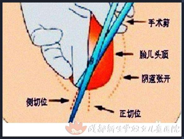 13周无痛引产步骤