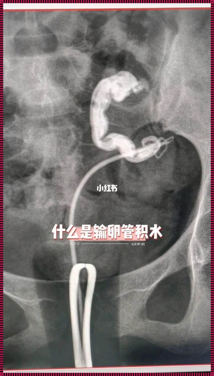 输卵管积水3厘米要做手术吗？揭秘输卵管积水的治疗之路