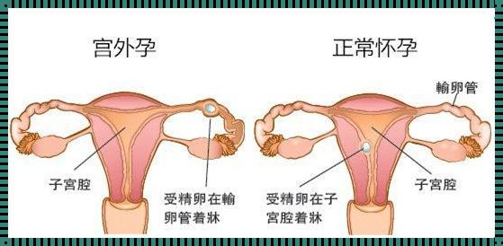 双侧宫外孕还能自然怀孕吗？揭秘