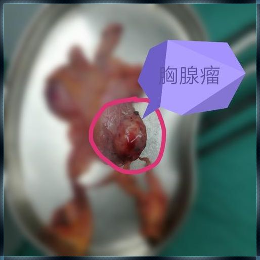 什么人容易得胸腺瘤：神秘面纱的探究