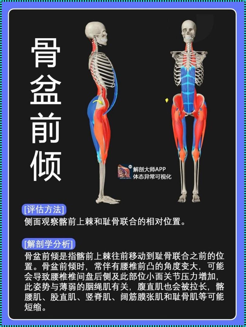 髂前上棘：突发疾病的隐蔽凶手