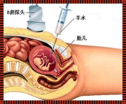 41岁怀孕：无创还是羊水穿刺，如何选择？