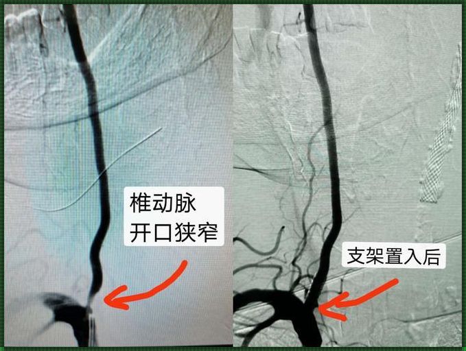 60岁以上不建议做颈动脉支架：深入探讨与理性思考