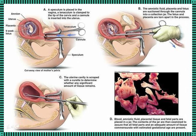 孕29周引产过程图解：技术与生命的交汇点