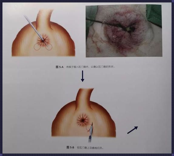 肛门边的系带有必要切除吗？——深入探讨医疗决策背后的因素