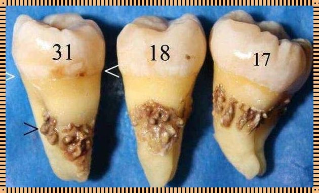 探讨牙结石0度到3度的图展现的口腔健康奥秘