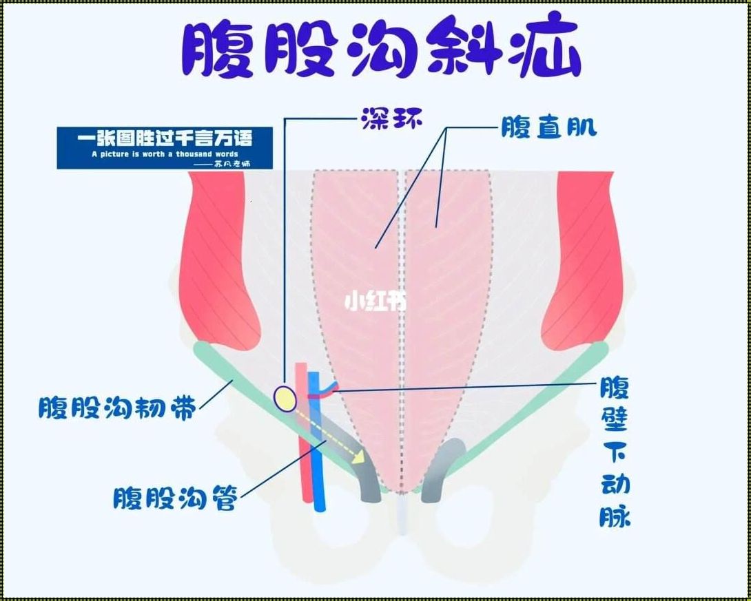 腹股沟斜疝是怎么样的：震惊的医学真相