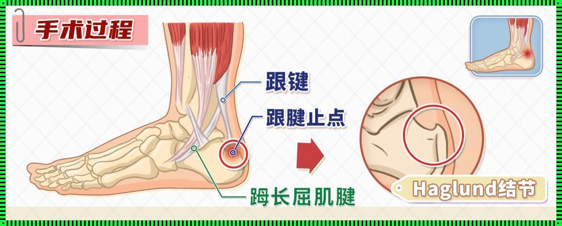 跟腱炎是哪个部位图：深入解析与自我诊断指南