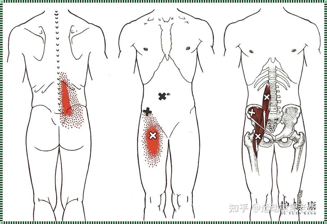 如何判断腰大肌损伤：身体警钟的惊现