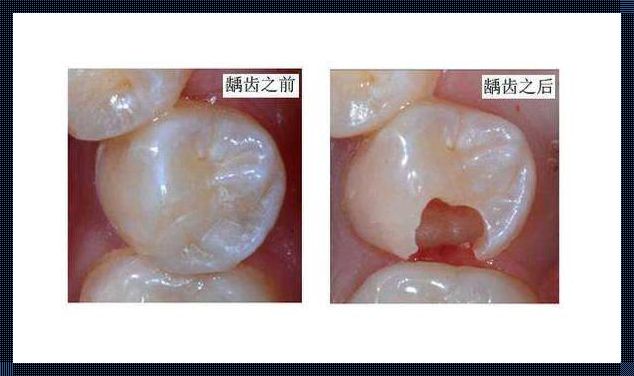 儿童磨牙有洞需要补吗