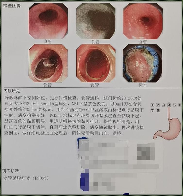 食道癌为什么不能手术：深入探讨手术限制的多重因素