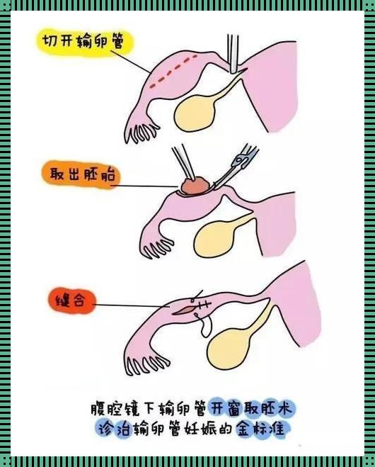 宫外孕几年才可以怀孕：女性健康与生育的深思