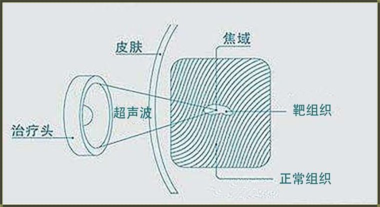 超声炮原理揭秘：科技与美学的完美结合