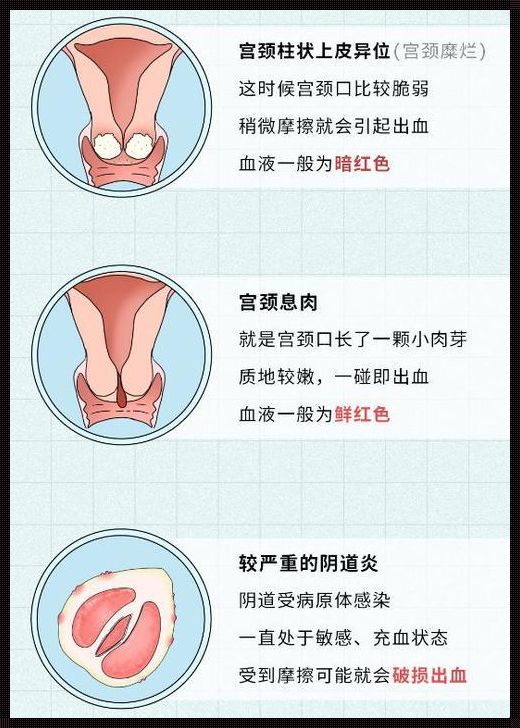 发生性后出血是会不会怀孕的：深入探讨性健康与怀孕的关联