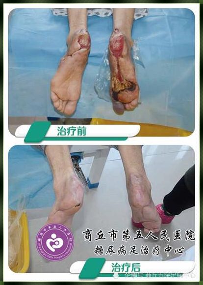 足底筋膜炎人就废了：惊现康复之路的曙光