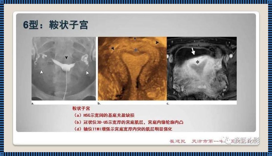 输卵管造影3D视频全过程：深入探索生育之路的关键一步