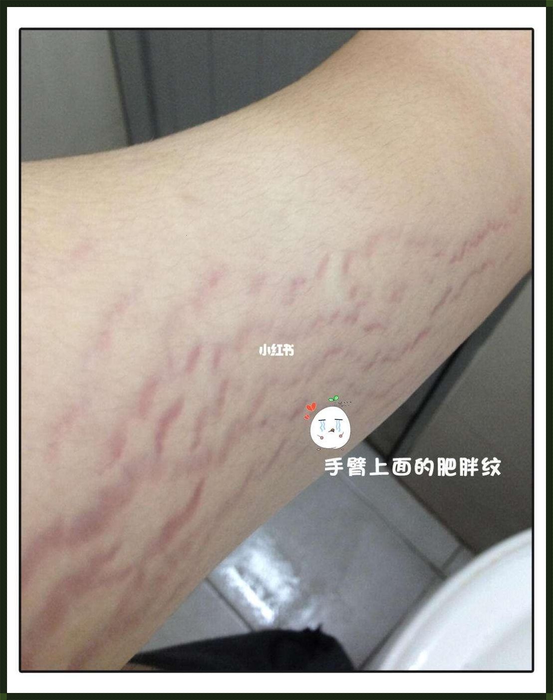 肥胖纹能去掉吗：揭秘惊现的真相与解决方案