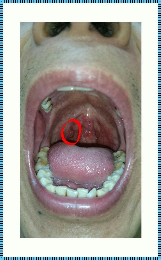 扁桃体下边连着长肉：一种医学现象的深入解析