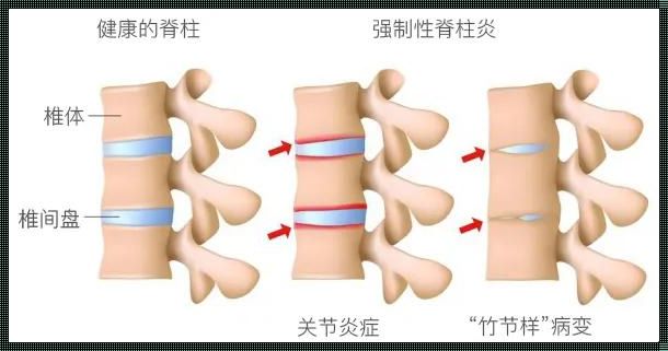 骶髂关节炎几级是强直：深入解析骶髂关节炎的分级与强直性脊柱炎的关联