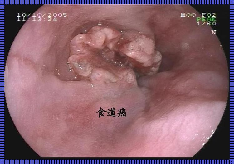 为什么说食道鳞癌好治愈：惊现医学奇迹的剖析