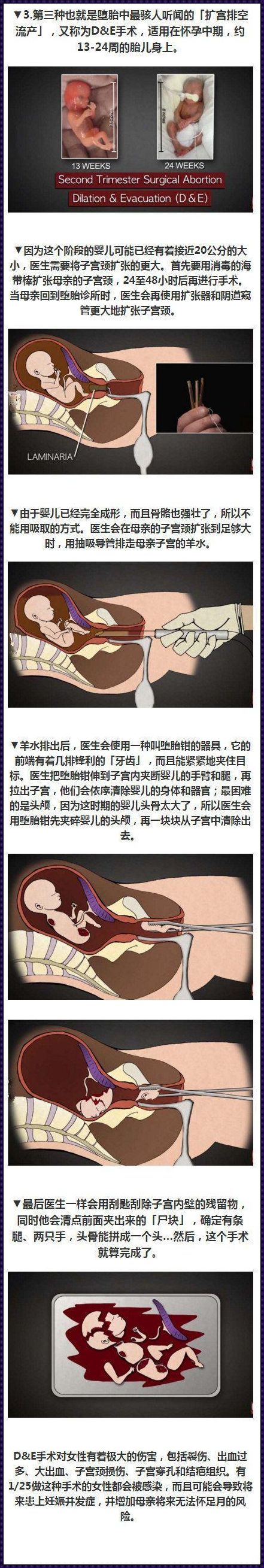 怀孕8周怎么打掉最安全