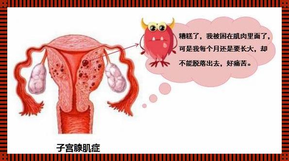 揭开神秘面纱：子宫腺肌症与怀孕的那些事儿