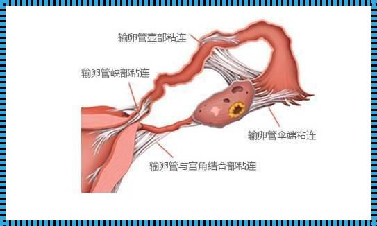 输卵管近端与远端治疗难度的探讨