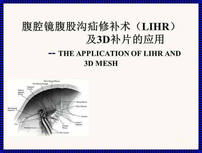 腹腔镜下疝修补术：健康领域的微创革新