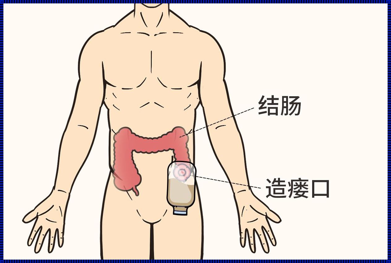 直肠癌终身不复发的可能性与希望