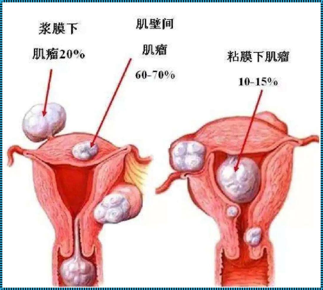 子宫肌瘤与意外怀孕：生命之花的奇迹与抉择