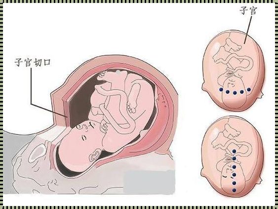 揭秘：剖腹产与寿命之谜