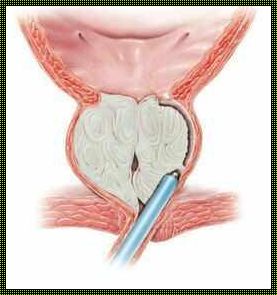 前列腺汽化切除术：育儿领域的神秘面纱