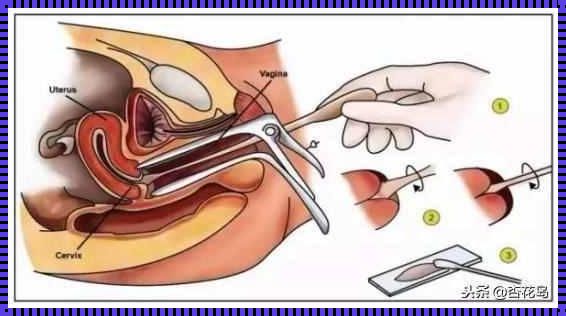 揭秘宫颈糜烂小手术：怀孕之路的保驾护航