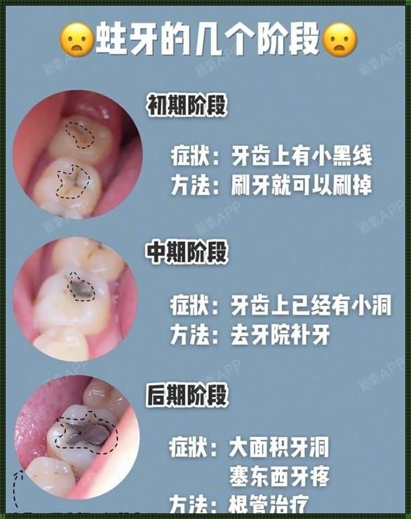 怀孕期间，牙根没了怎么补牙？揭秘其中神秘面纱！