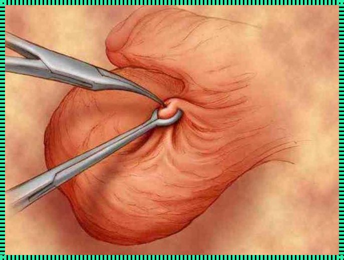 剖腹产时直接结扎：利弊几何？