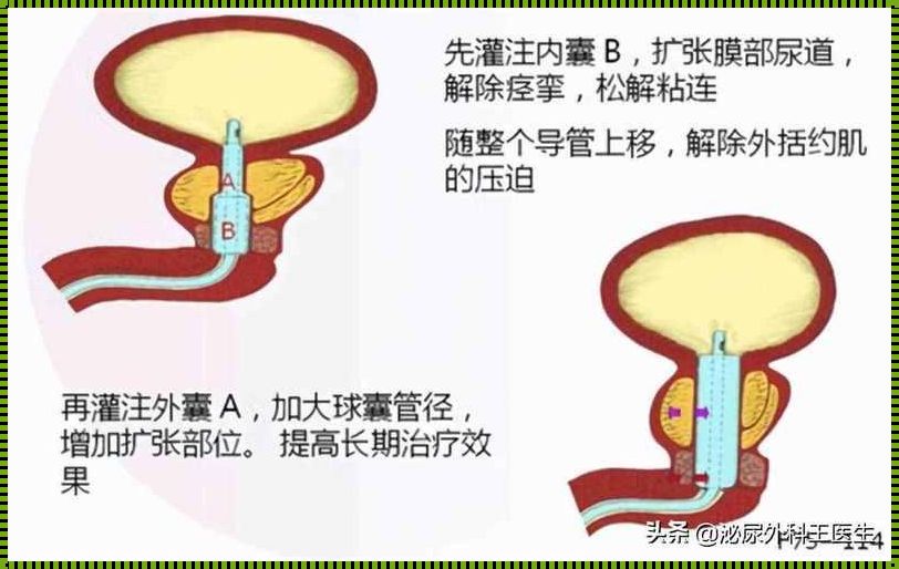 调皮风格的文章：前列腺增生伴钙化的最佳治疗方法