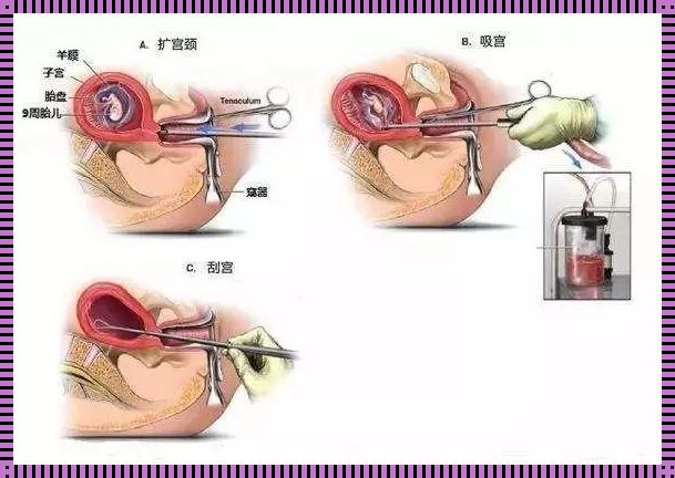 “无痛宫腔镜人流手术”的调皮见解：育儿路上的奇幻漂流