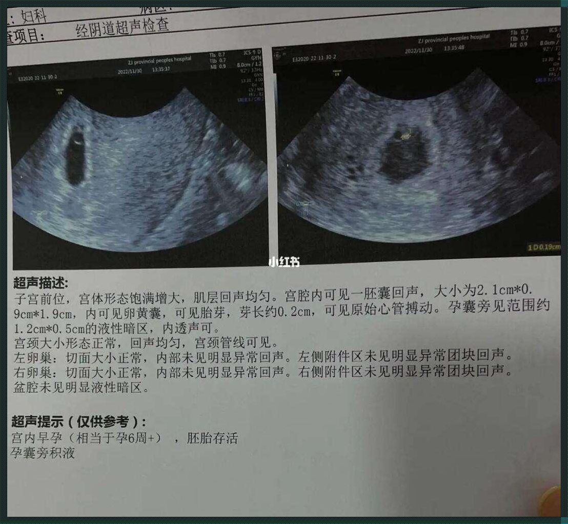 孕囊旁积液，是躺还是走？这个“游泳圈”让妈妈们纠结不已！