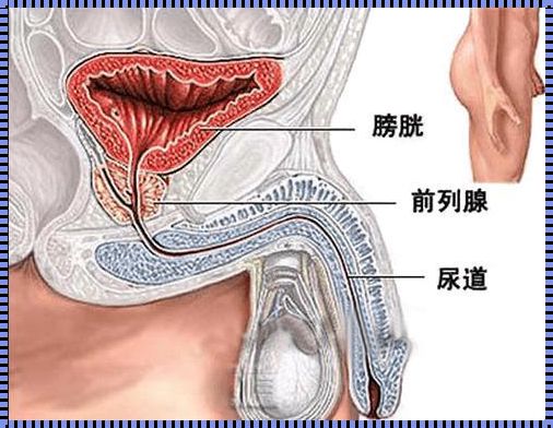 前列腺结石的自我疗法：一场与体内的“小石头”的较量