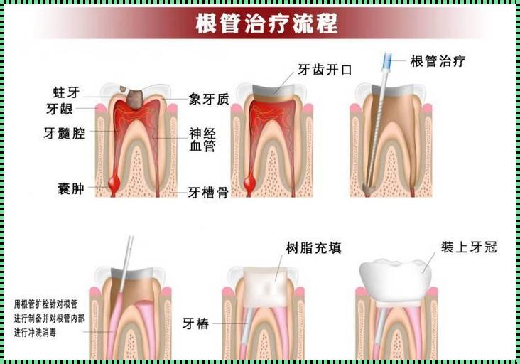 牙髓根管治疗后牙齿寿命：漫游在微笑的时光里