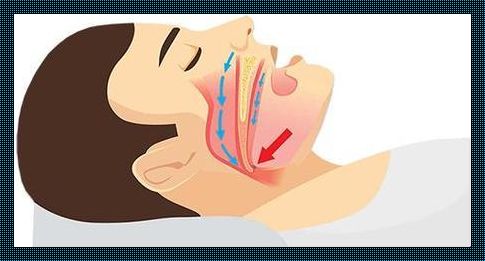 咽喉狭窄打呼噜的手术多少钱？揭秘背后的“秘密”