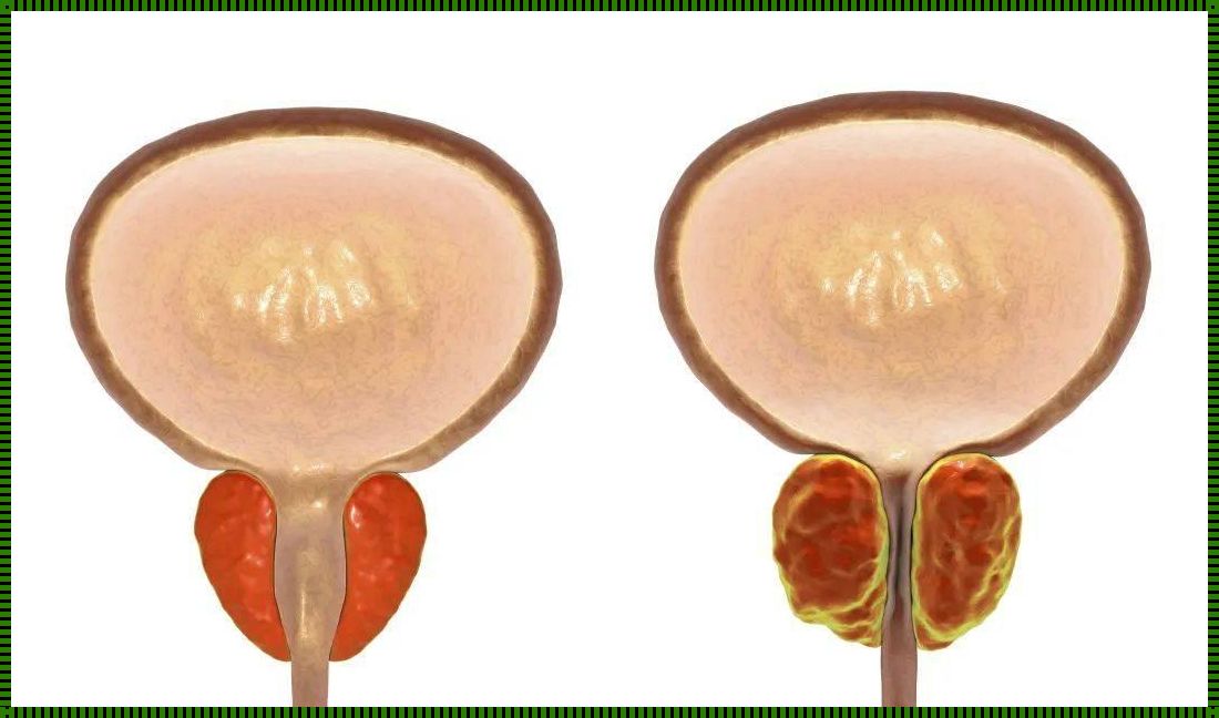 前列腺钙化：欲望的“勋章”还是“陷阱”?